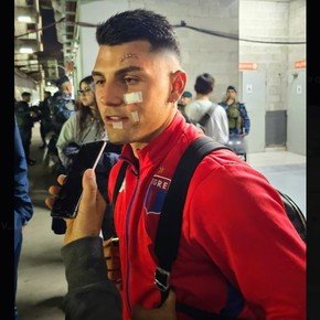 Cómo le quedó la cara a Nacho Russo tras los cortes sufridos en Tigre vs. San Lorenzo por Copa Argentina