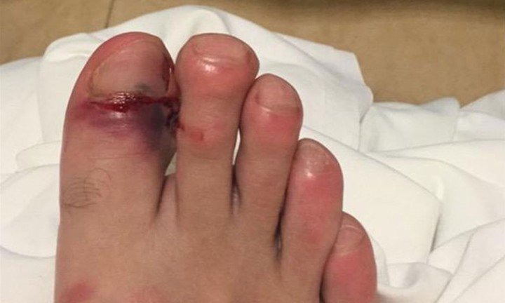 Así le quedó el dedo de Gignac después del partido de ida.