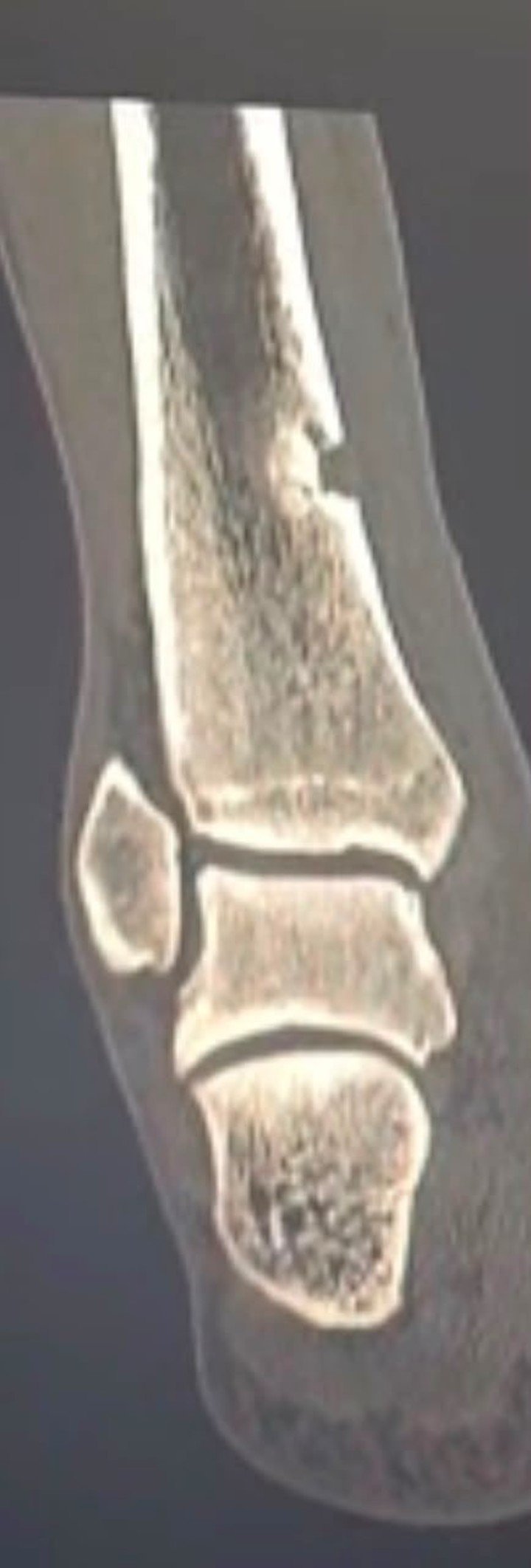 La fractura de tibia de Lucas Di Yorio. (Foto: X)
