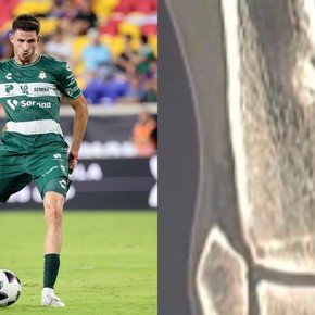 A un argentino le rompieron una parte del hueso de la tibia en la Leagues Cup pero el árbitro no mostró ni la amarilla y el VAR tampoco la revisó